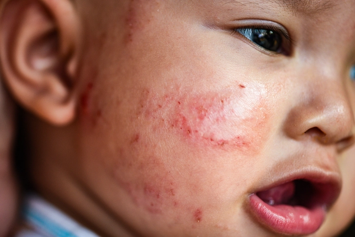 Help for Atopic Dermatitis in Babies Help for Atopic Dermatitis in Babies