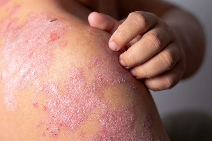 Relief for Eczema and Psoriasis Relief for Eczema and Psoriasis