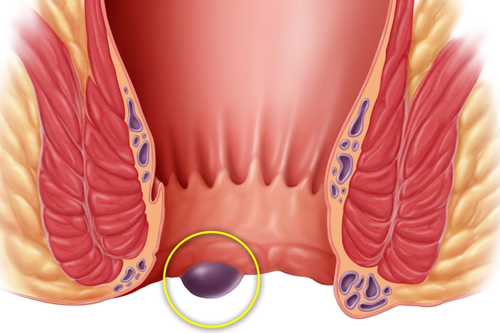 Hemorrhoid Help Hemorrhoid Help