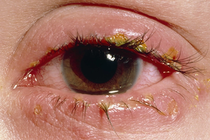 Symptom: Crusty Eyelids Symptom: Crusty Eyelids