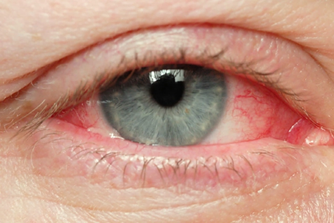Symptom: Eye Redness