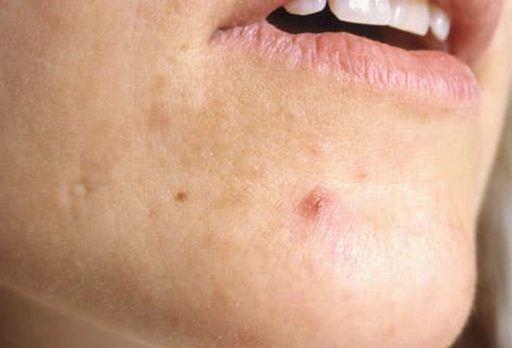 Symptoms of PMS: Acne