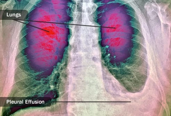 Complication: Pleural Effusion