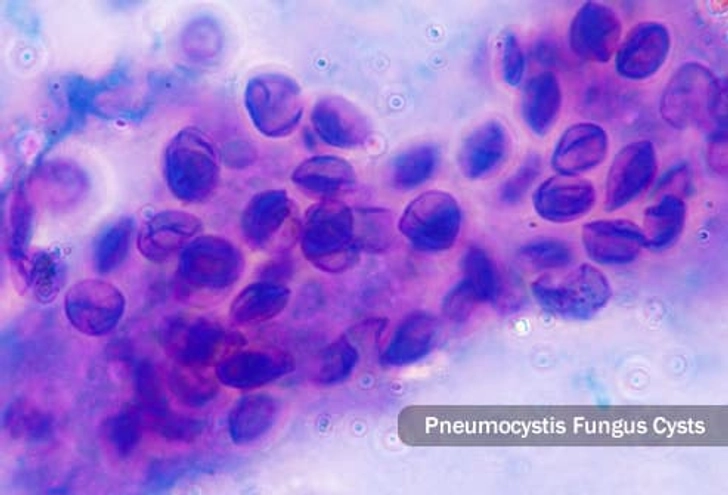 Cause: Fungi