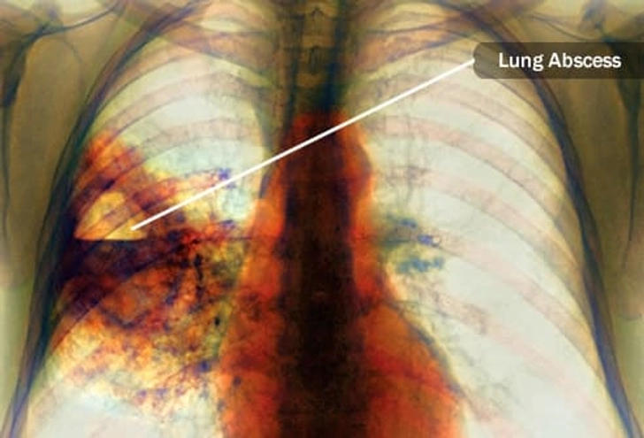 Complication: Lung Abscess