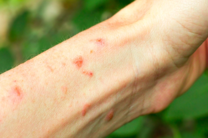 The Rash Shows Up Right Away The Rash Shows Up Right Away