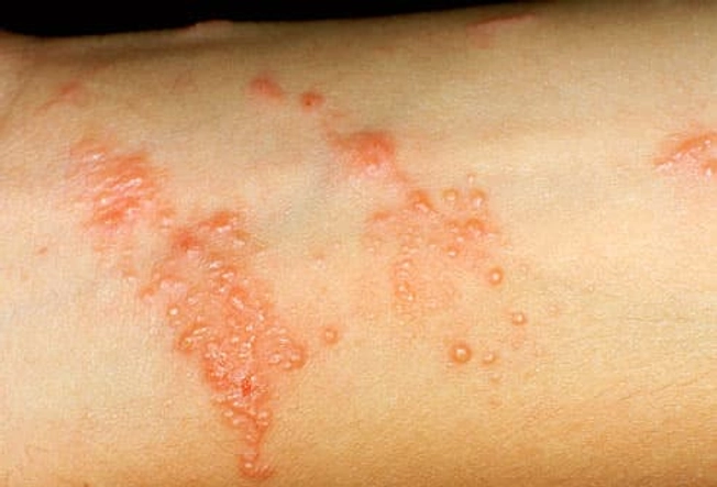 The Rash Shows Up Right Away
