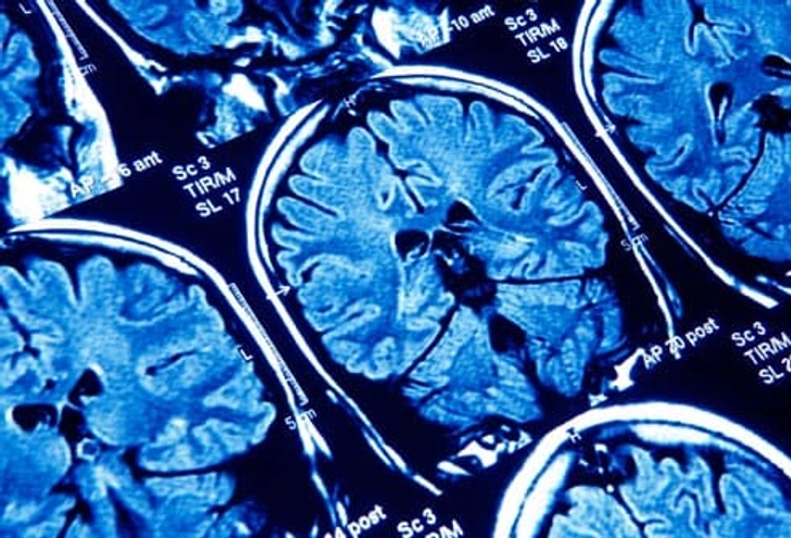 What Is Postpartum Psychosis?