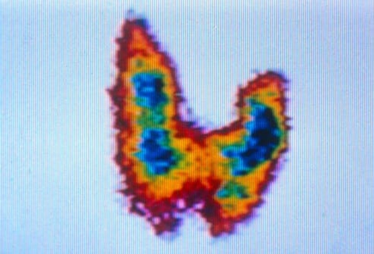 Depression or Thyroid Disorder?