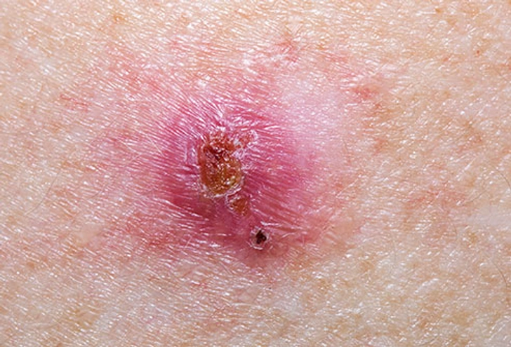 Basal Cell Carcinoma Basal Cell Carcinoma