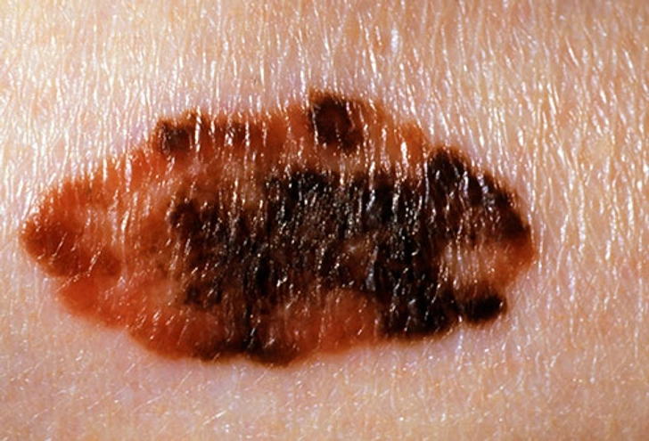 Melanoma Melanoma