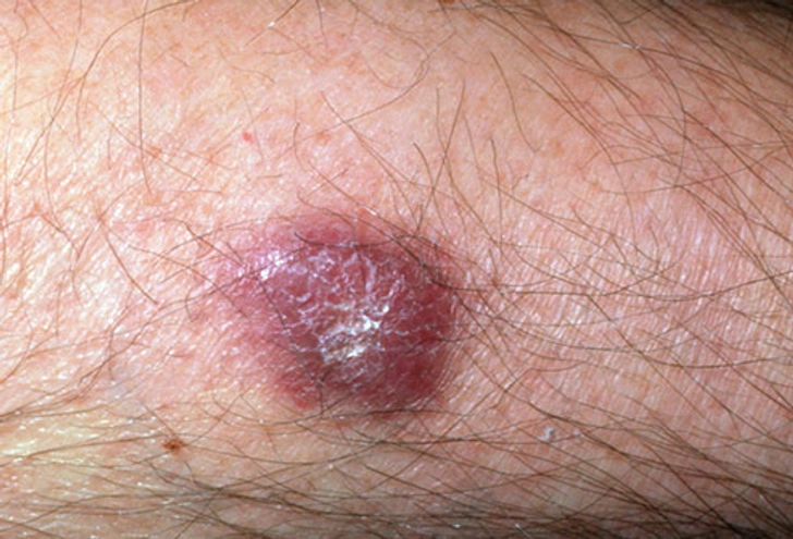 Kaposi's Sarcoma