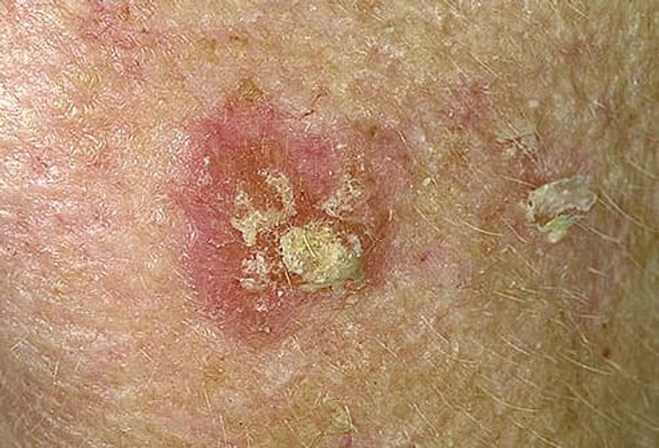 Actinic Keratosis (Solar Keratosis)