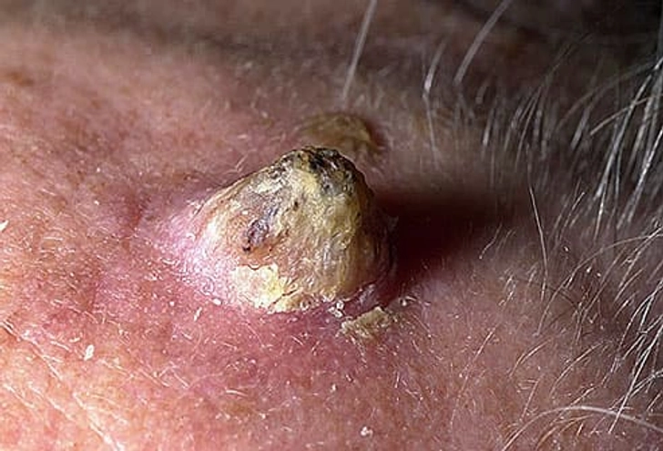 Cutaneous Horns