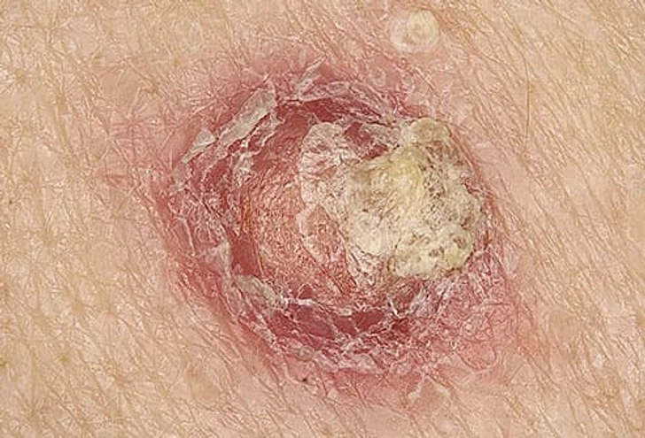 Squamous Cell Carcinoma Squamous Cell Carcinoma