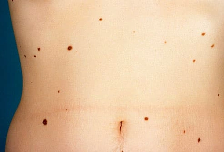 Dysplastic Nevi (Atypical Moles) Dysplastic Nevi (Atypical Moles)
