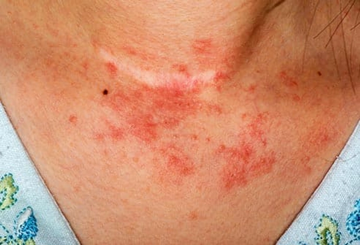 Eczema Eczema