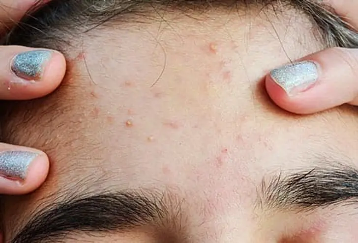 Acne Acne