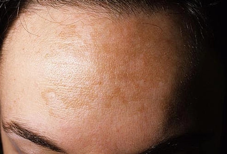 Melasma Melasma