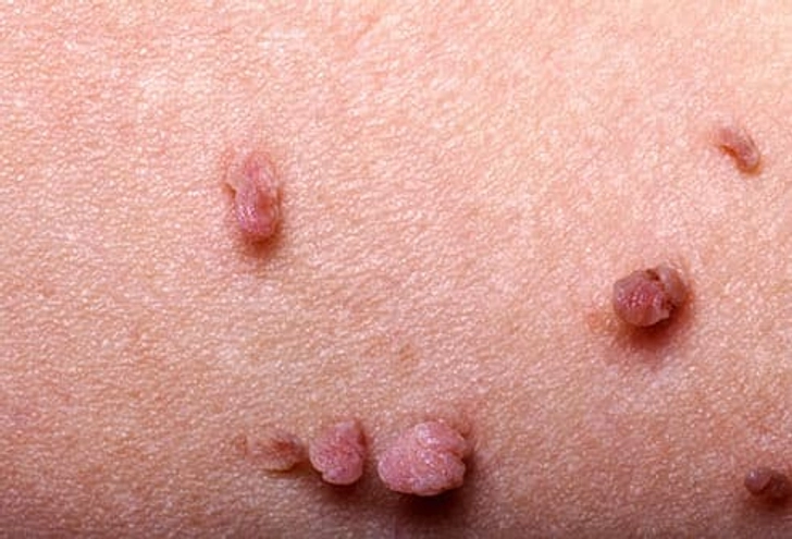 Skin Tags Skin Tags
