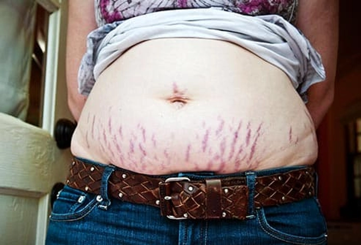 Stretch Marks