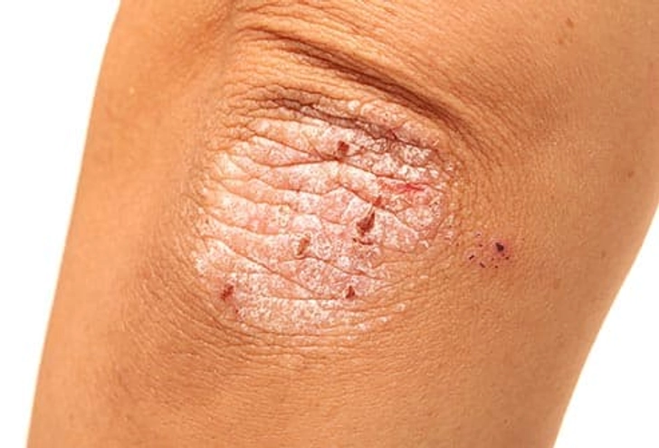 Psoriasis Psoriasis