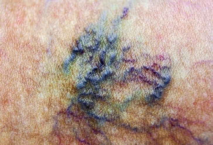 Varicose and Spider Veins Varicose and Spider Veins