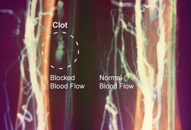 Are You at Risk for Blood Clots?