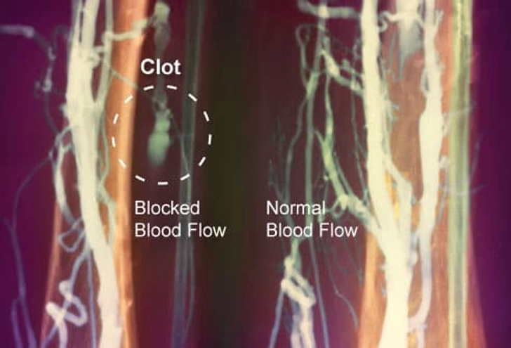 Are You at Risk for Blood Clots? Are You at Risk for Blood Clots?
