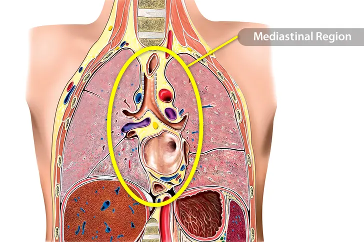 Primary Mediastinal B-Cell Lymphoma (PMBCL) Primary Mediastinal B-Cell Lymphoma (PMBCL)