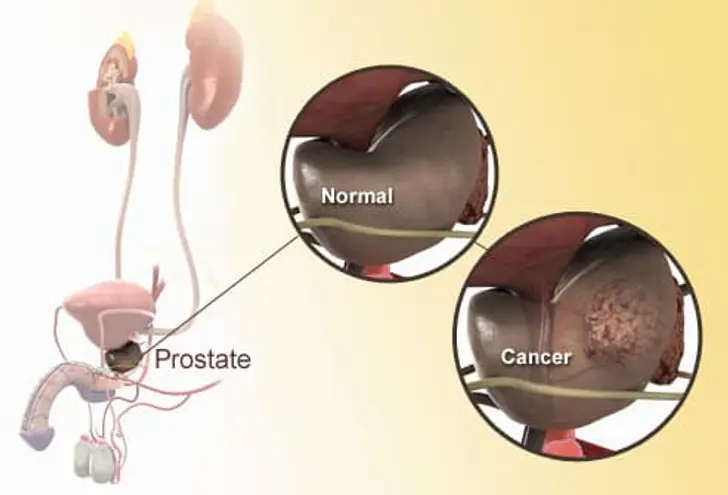 What Is Prostate Cancer? What Is Prostate Cancer?