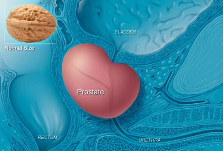 Enlarged Prostate or Prostate Cancer? Enlarged Prostate or Prostate Cancer?