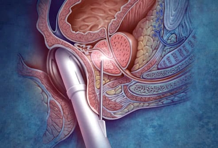Prostate Cancer Biopsy