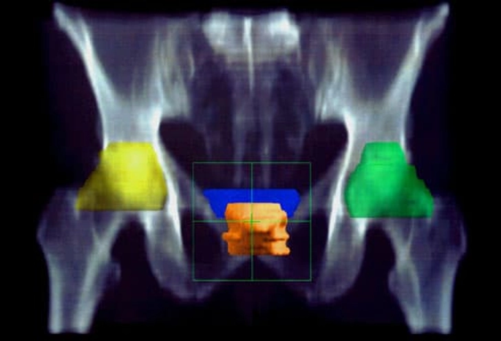 Treatment: Radiation Therapy
