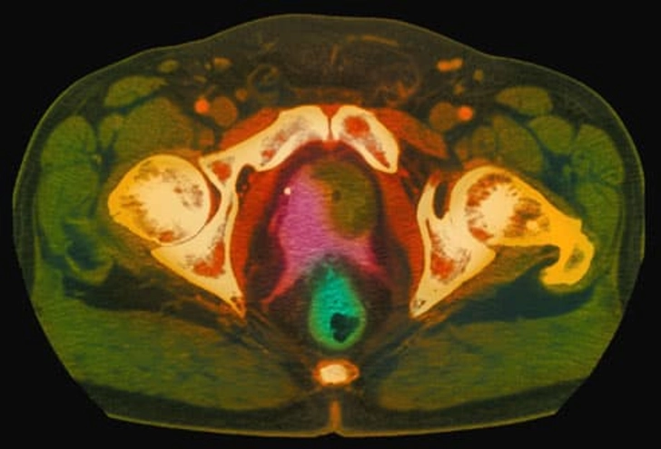 Prostate Cancer Imaging