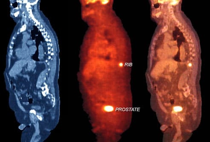 Prostate Cancer Staging