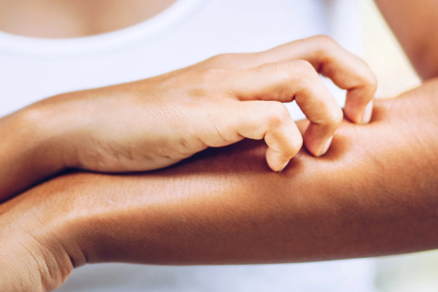 photo of woman scratching dry skin on arm