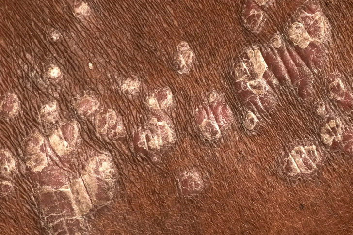 Psoriasis Looks Different on Dark Skin