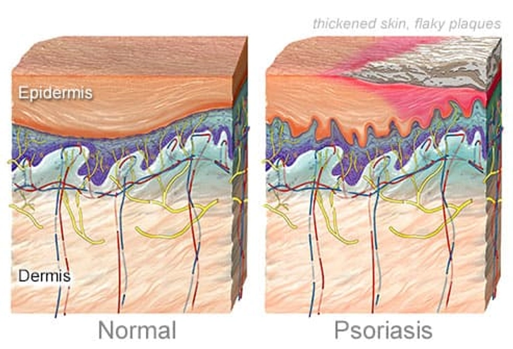 What Causes Psoriasis? What Causes Psoriasis?