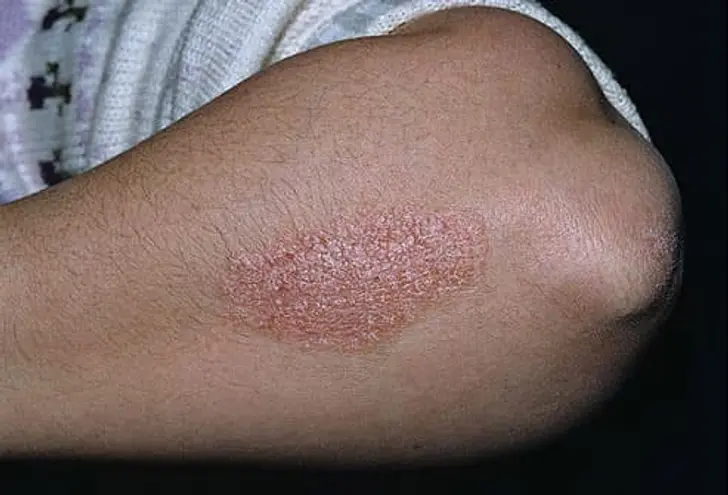 What Is Psoriasis? What Is Psoriasis?