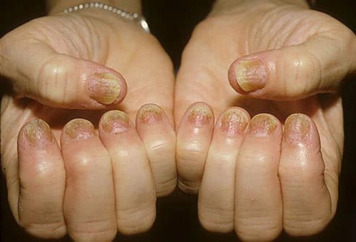 Nail Psoriasis