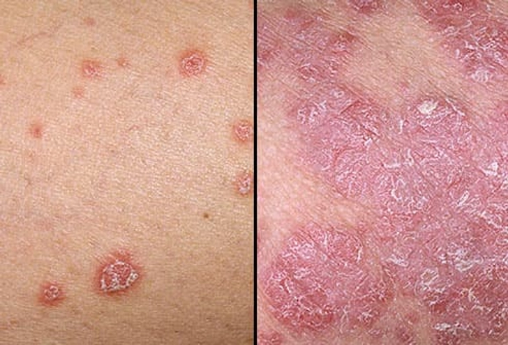 Psoriasis on Lighter Skin Psoriasis on Lighter Skin