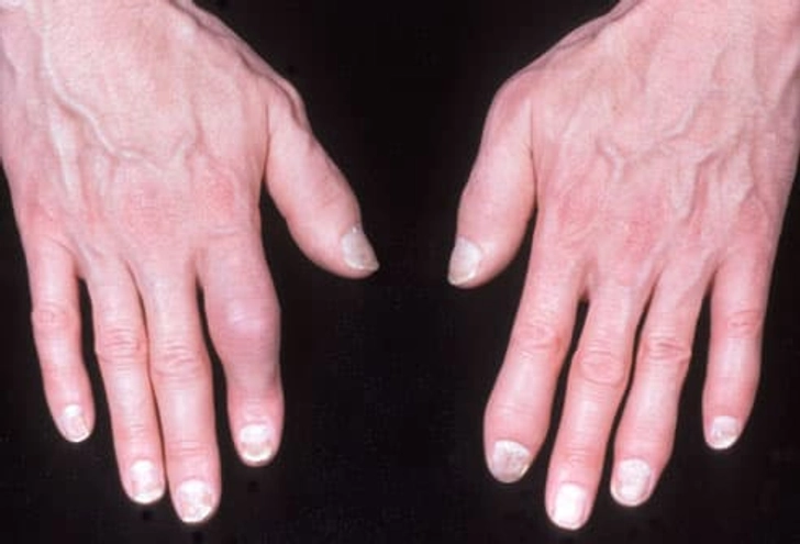Psoriatic Arthritis