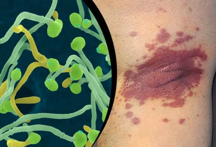 Infections Infections