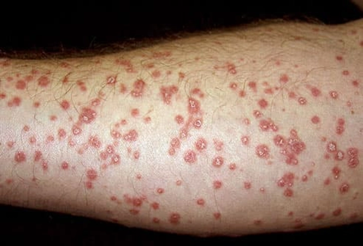 Guttate Psoriasis