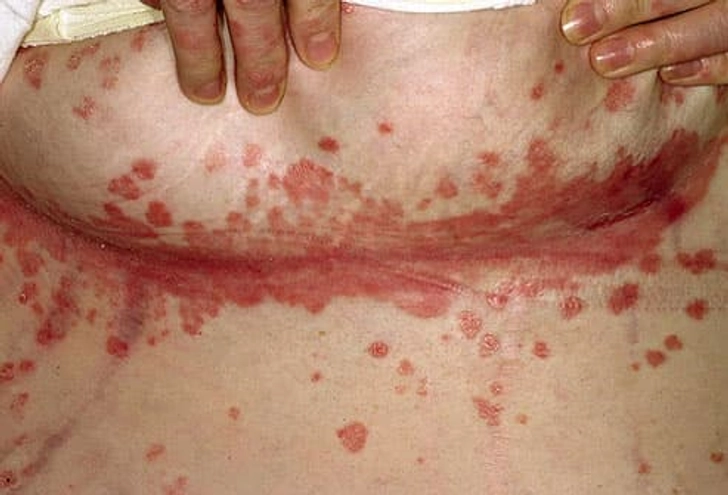 Inverse Psoriasis