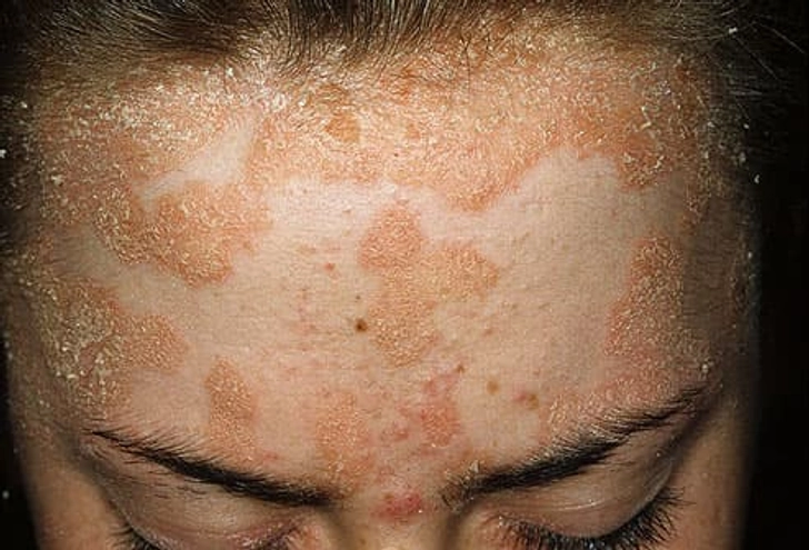 Scalp Psoriasis