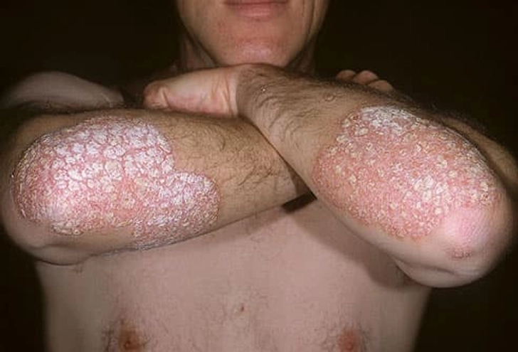 Plaque Psoriasis