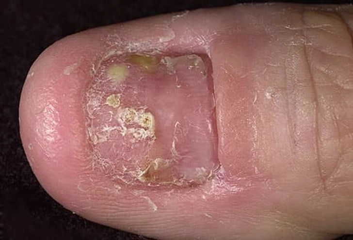 Psoriatic Nail Disease