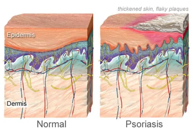 Psoriasis: Too Many Skin Cells
